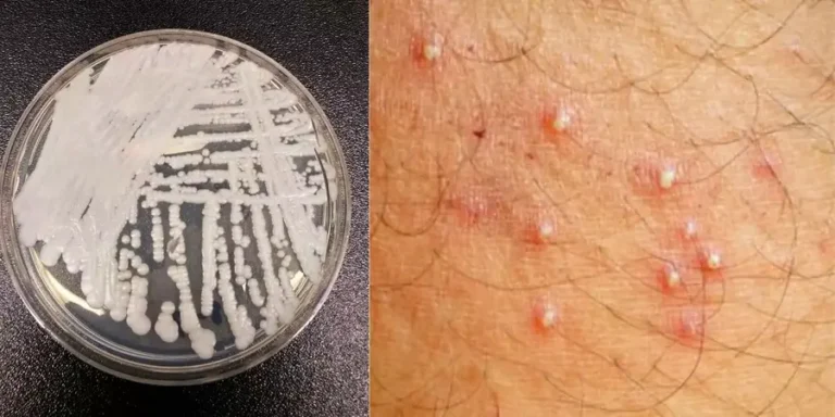 Candida-auris