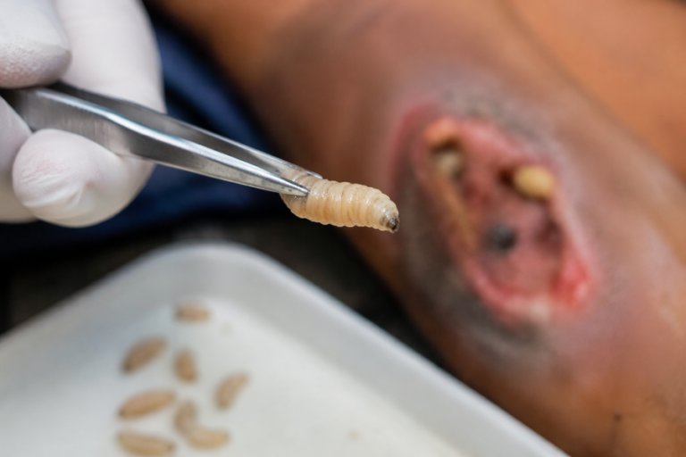 Examen-forense-de-larva-en-herida-1